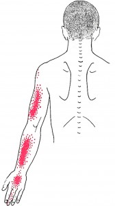 Coracobrachialis smerteområde