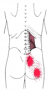 Quadratus lumborum Smerteområde