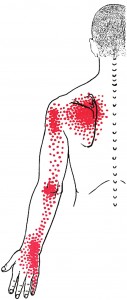 Serratus posterior superior smerteområde