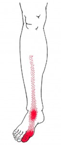 Tibialis anterior smerteområde