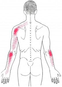 Triceps brachii smerteområde