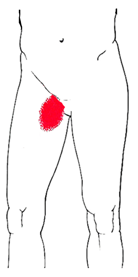 Quadratus femoris smerteområde