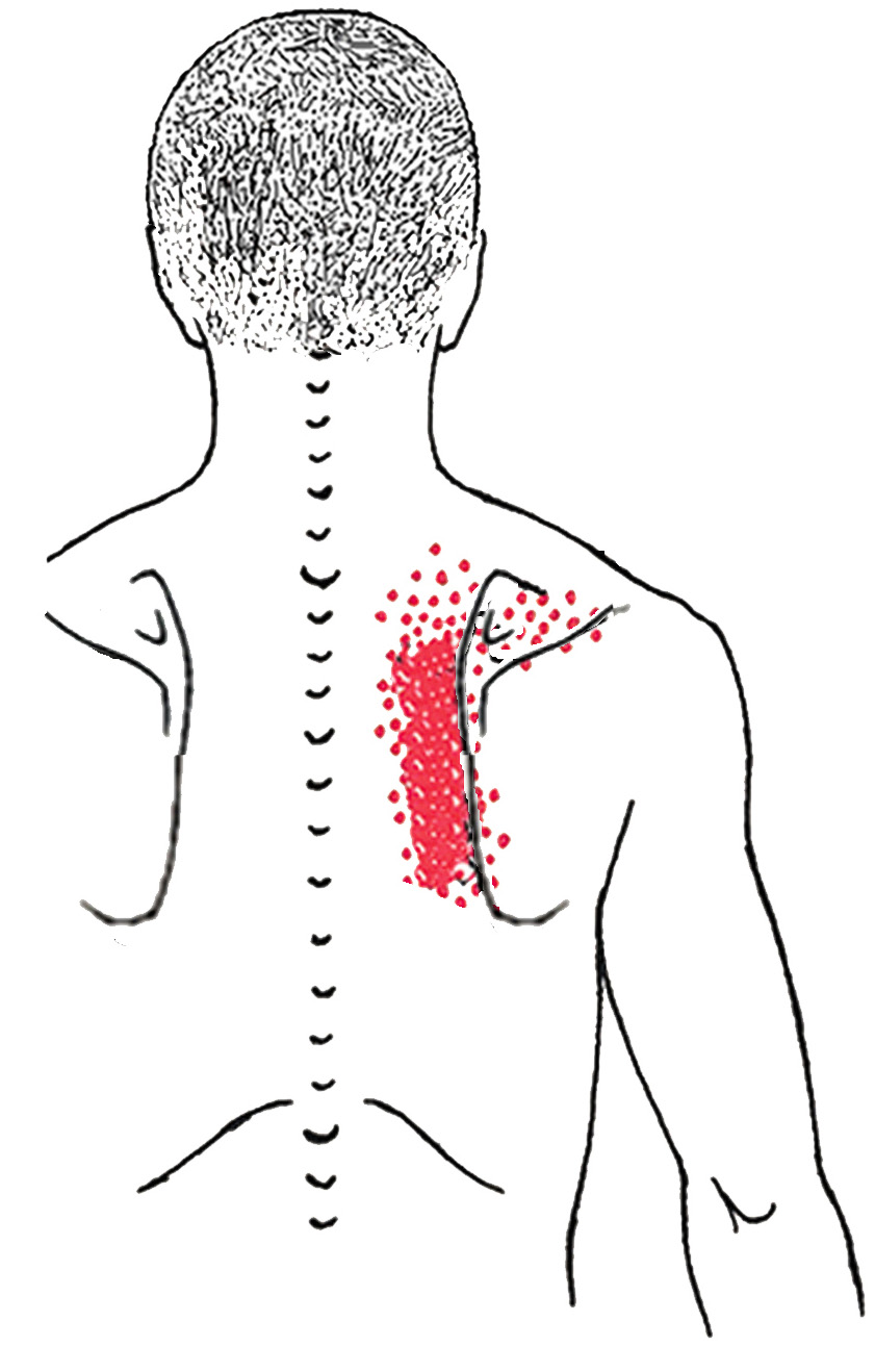 Rhomboideus smerteområde