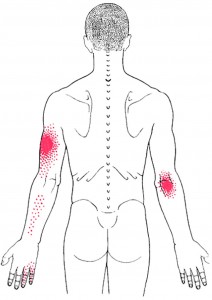 Triceps brachii smerteområde